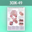 Плакат «Хроническая обструктивная болезнь легких (ХОБЛ)» (ЗОЖ-49, ламинированная бумага, А2, 1 лист)
